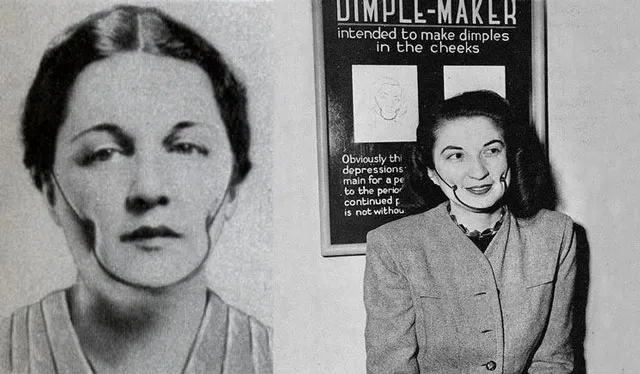 Black-and-white photos of a woman wearing a 1930s Dimple-Maker face brace beside its advertisement